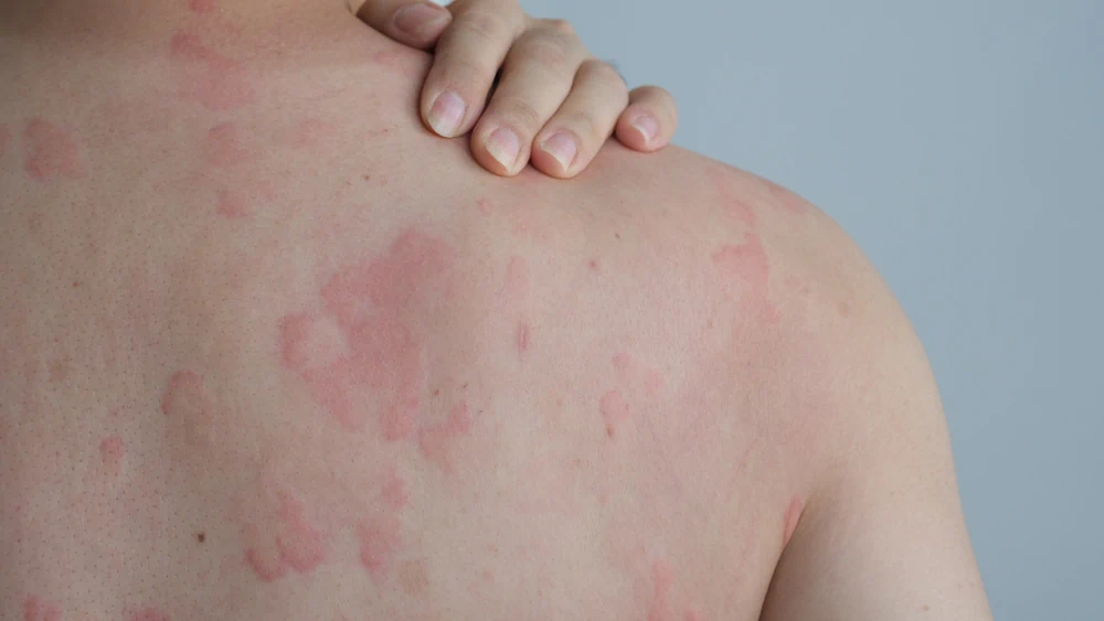 Allergy Specialist In Nepal
