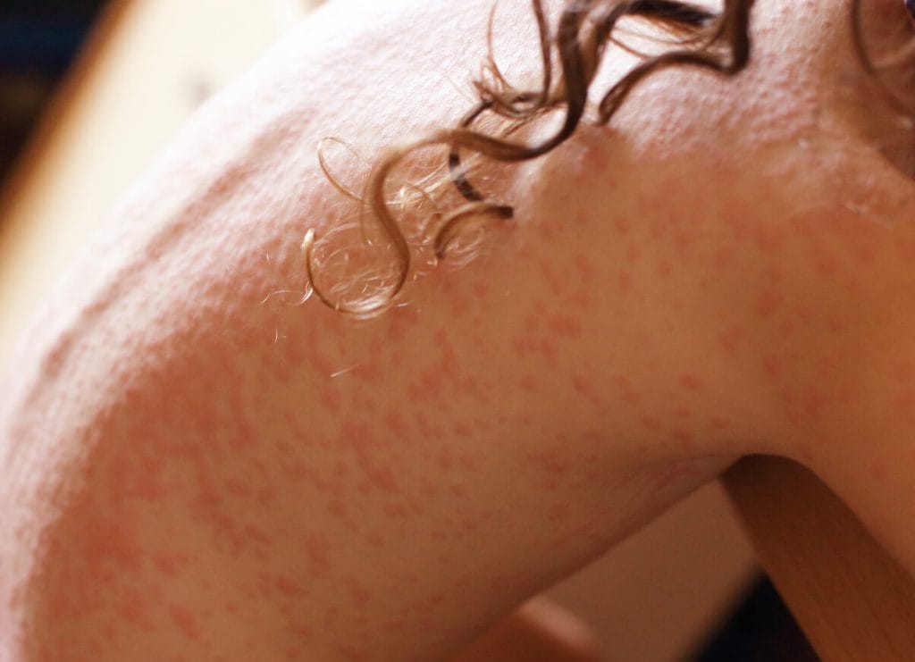 Allergy Treatment Center In Kathmandu