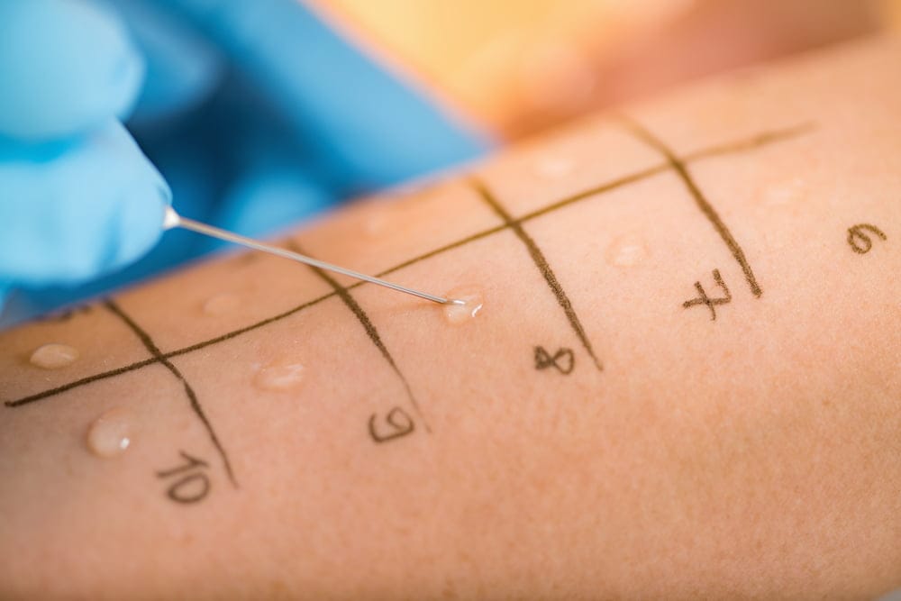 skin prick test in nepal